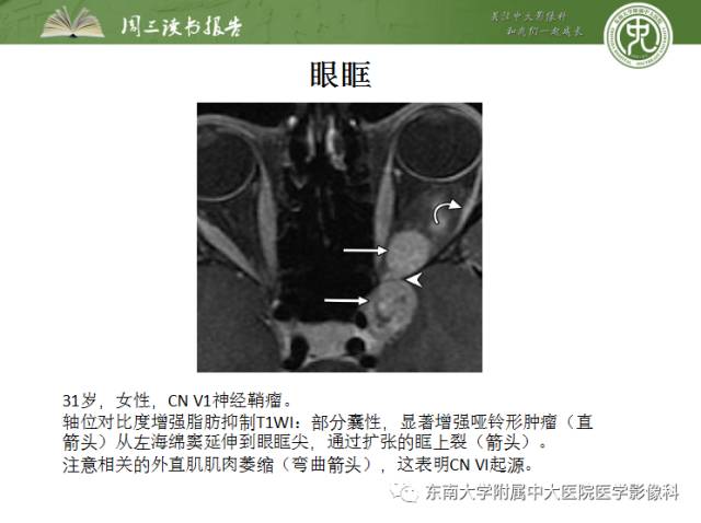 【PPT】颅神经神经鞘瘤：影像学诊断方法