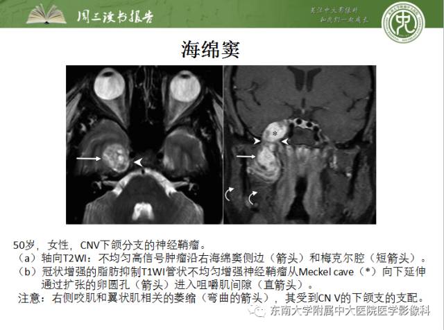 【PPT】颅神经神经鞘瘤：影像学诊断方法