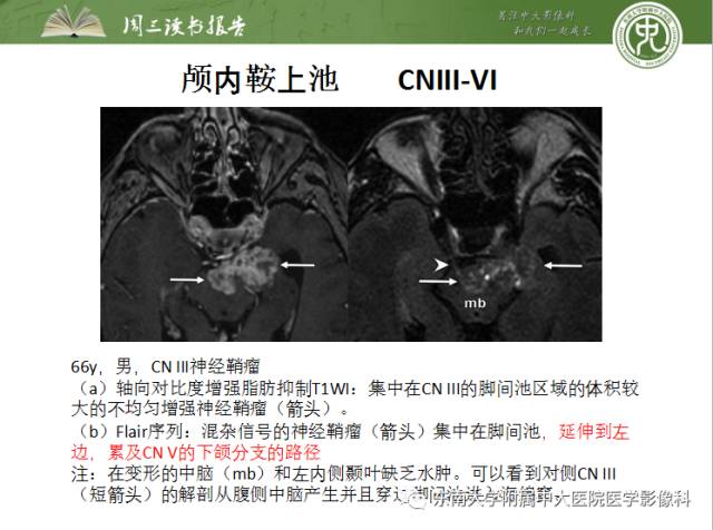 【PPT】颅神经神经鞘瘤：影像学诊断方法