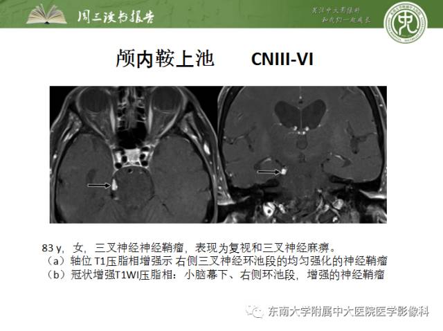 【PPT】颅神经神经鞘瘤：影像学诊断方法