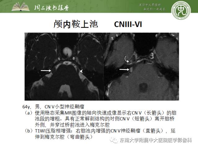 【PPT】颅神经神经鞘瘤：影像学诊断方法