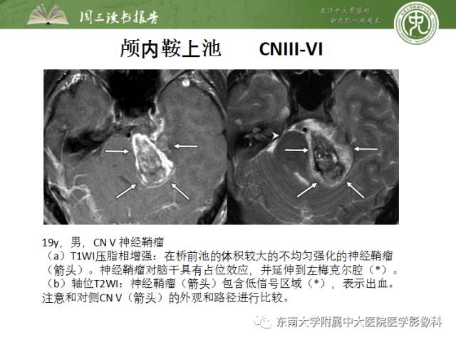 【PPT】颅神经神经鞘瘤：影像学诊断方法