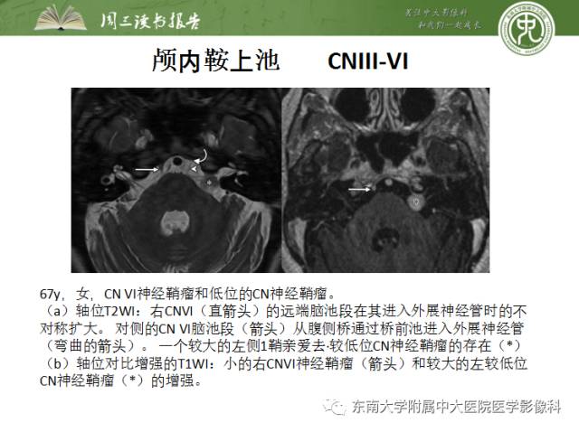 【PPT】颅神经神经鞘瘤：影像学诊断方法