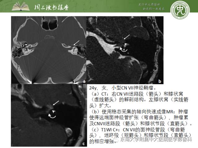 【PPT】颅神经神经鞘瘤：影像学诊断方法