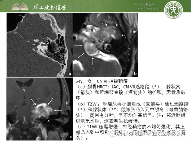 【PPT】颅神经神经鞘瘤：影像学诊断方法