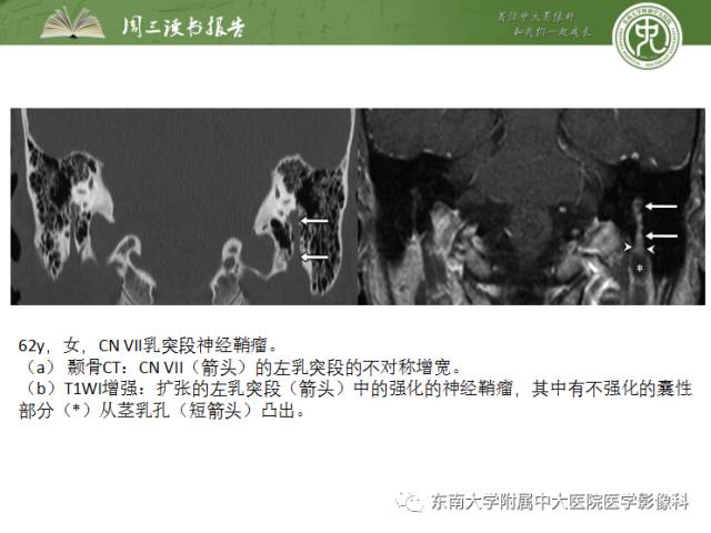 【PPT】颅神经神经鞘瘤：影像学诊断方法