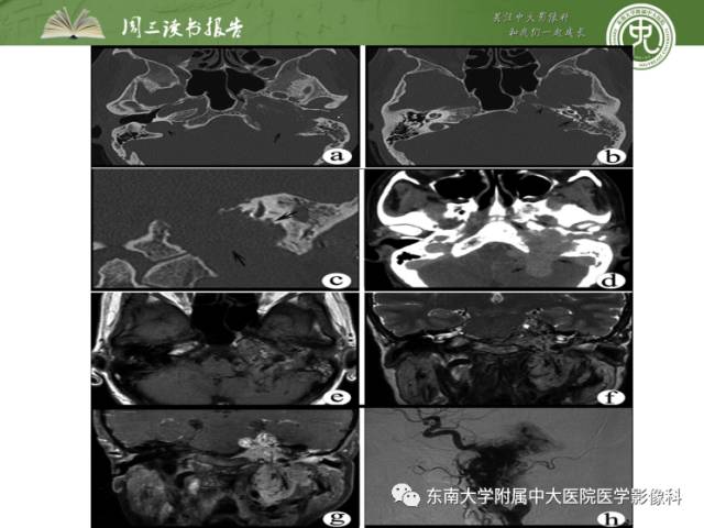 【PPT】颅神经神经鞘瘤：影像学诊断方法
