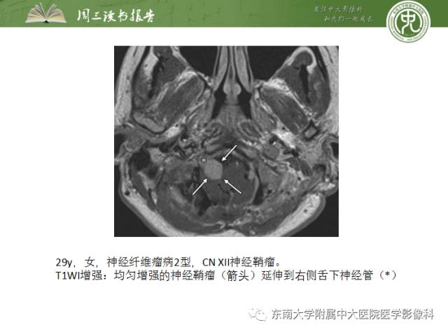 【PPT】颅神经神经鞘瘤：影像学诊断方法