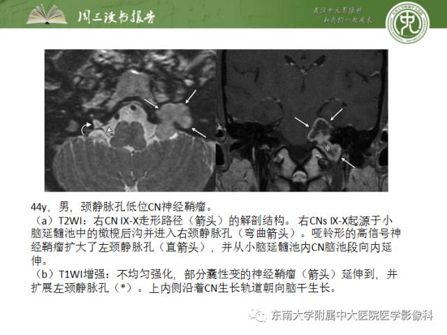 【PPT】颅神经神经鞘瘤：影像学诊断方法