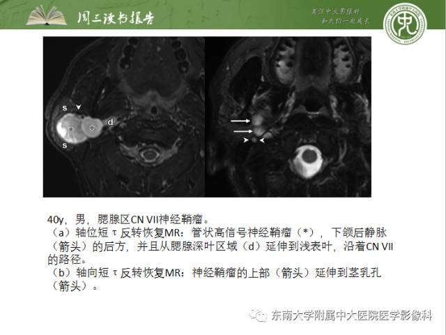 【PPT】颅神经神经鞘瘤：影像学诊断方法