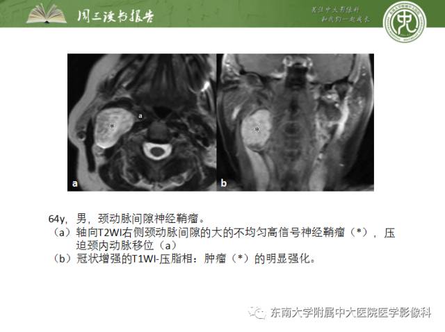 【PPT】颅神经神经鞘瘤：影像学诊断方法