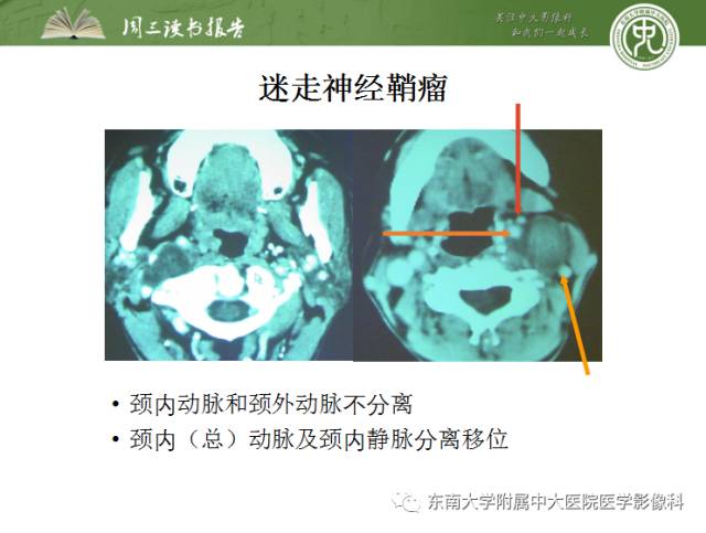 【PPT】颅神经神经鞘瘤：影像学诊断方法