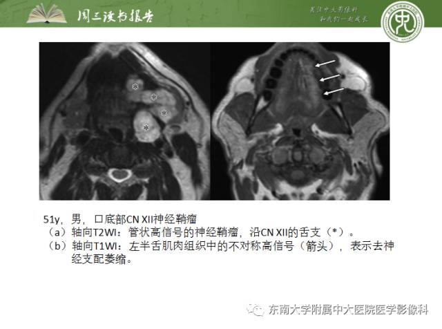 【PPT】颅神经神经鞘瘤：影像学诊断方法