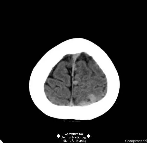 【病例】脑动静脉畸形1例CT影像表现