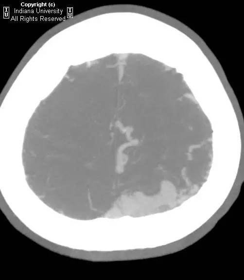 【病例】脑动静脉畸形1例CT影像表现 【病例】脑动静脉畸形1例CT影像表现