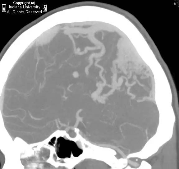 【病例】脑动静脉畸形1例CT影像表现 【病例】脑动静脉畸形1例CT影像表现