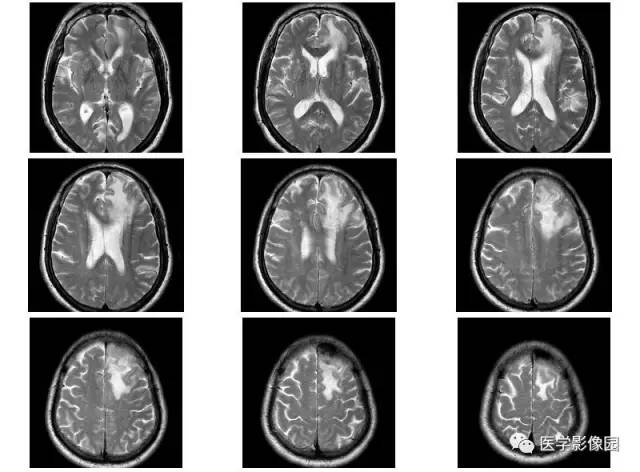 【病例】脑膜慢性炎症伴淋巴组织增生1例CT