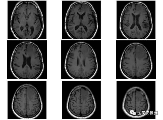 【病例】脑膜慢性炎症伴淋巴组织增生1例CT 【病例】脑膜慢性炎症伴淋巴组织增生1例CT