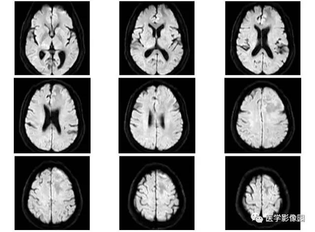 【病例】脑膜慢性炎症伴淋巴组织增生1例CT 【病例】脑膜慢性炎症伴淋巴组织增生1例CT