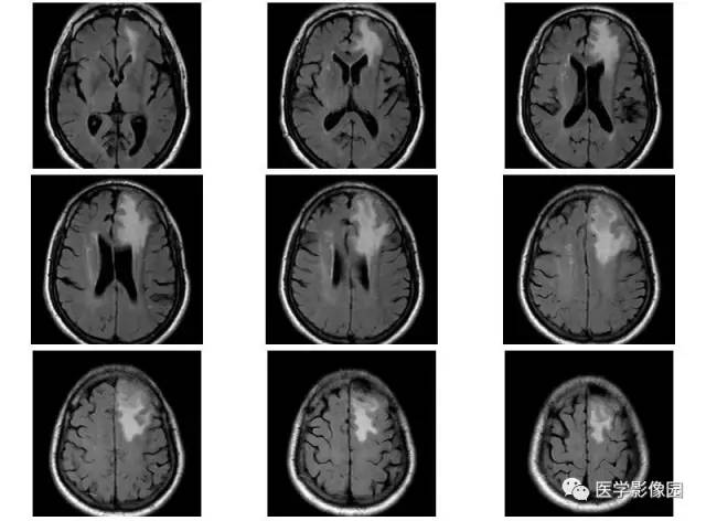 【病例】脑膜慢性炎症伴淋巴组织增生1例CT 【病例】脑膜慢性炎症伴淋巴组织增生1例CT