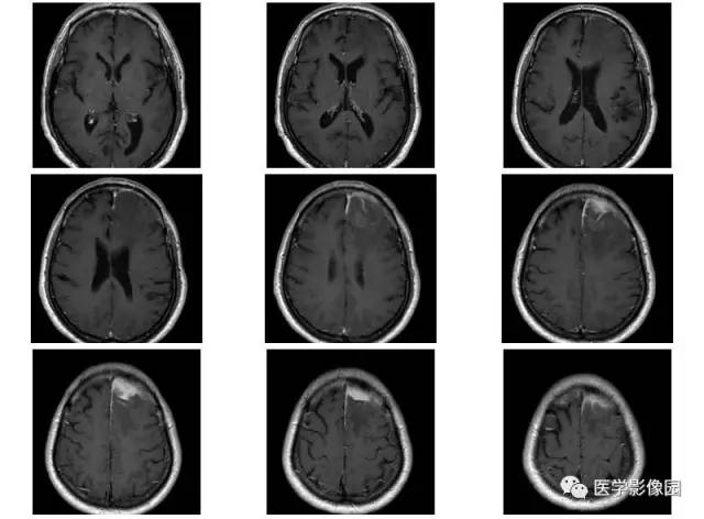 【病例】脑膜慢性炎症伴淋巴组织增生1例CT 【病例】脑膜慢性炎症伴淋巴组织增生1例CT