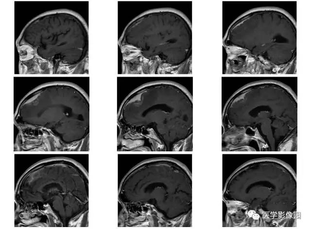 【病例】脑膜慢性炎症伴淋巴组织增生1例CT 【病例】脑膜慢性炎症伴淋巴组织增生1例CT