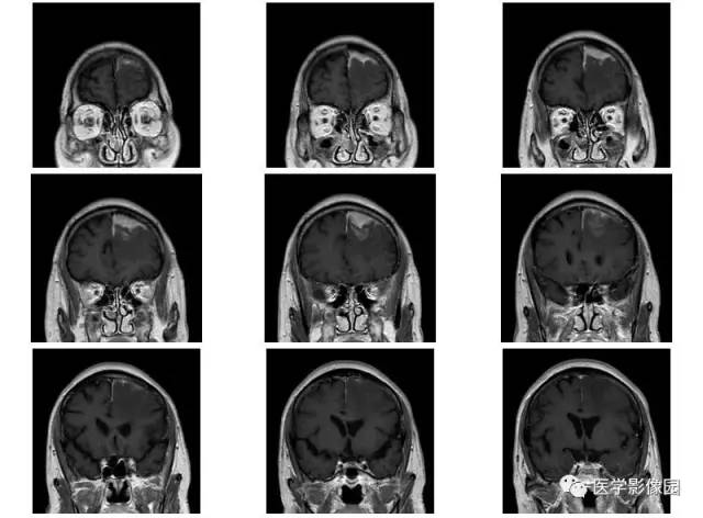 【病例】脑膜慢性炎症伴淋巴组织增生1例CT 【病例】脑膜慢性炎症伴淋巴组织增生1例CT