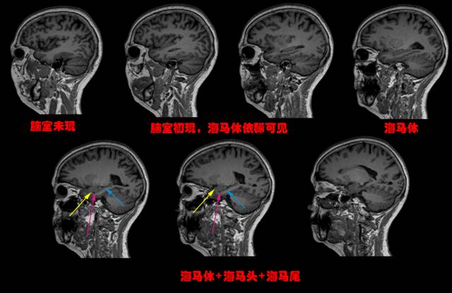 几个小技巧,教你在MRI上轻松识别边缘系统 几个小技巧,教你在MRI上轻松识别边缘系统