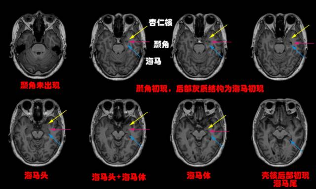 几个小技巧,教你在MRI上轻松识别边缘系统 几个小技巧,教你在MRI上轻松识别边缘系统