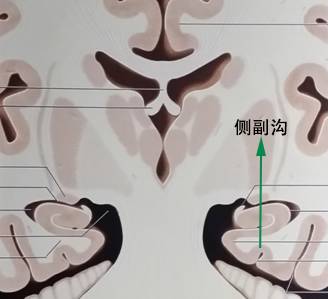 几个小技巧,教你在MRI上轻松识别边缘系统 几个小技巧,教你在MRI上轻松识别边缘系统