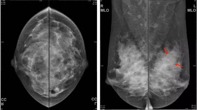 【病例】乳腺腺病1例X线MR影像表现