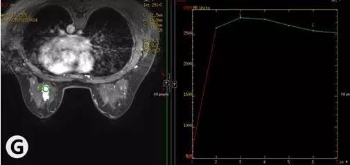 【病例】乳腺腺病1例X线MR影像表现