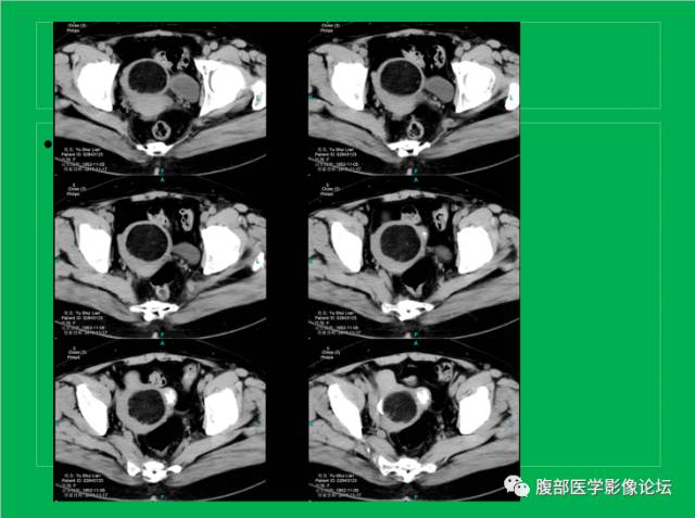 【病例】子宫肌瘤伴脂肪样变1例CT