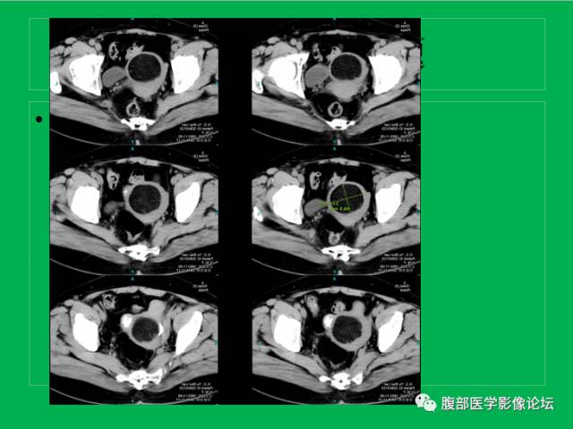 【病例】子宫肌瘤伴脂肪样变1例CT