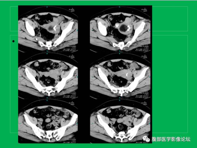 【病例】子宫肌瘤伴脂肪样变1例CT
