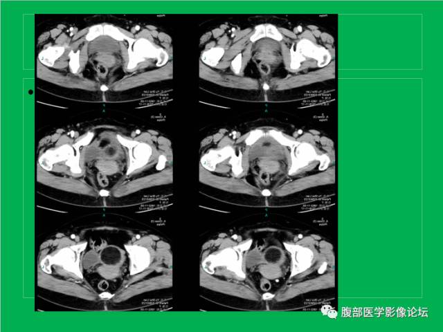 【病例】子宫肌瘤伴脂肪样变1例CT