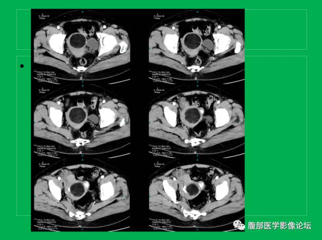 【病例】子宫肌瘤伴脂肪样变1例CT