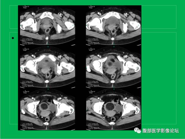 【病例】子宫肌瘤伴脂肪样变1例CT
