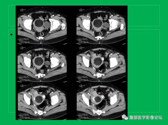 【病例】子宫肌瘤伴脂肪样变1例CT