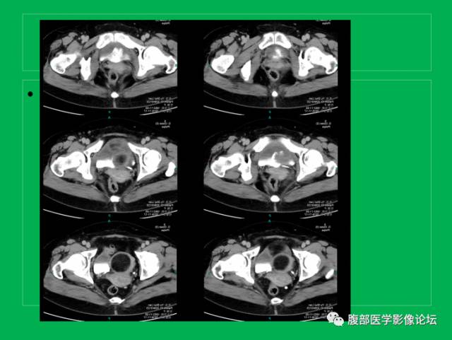 【病例】子宫肌瘤伴脂肪样变1例CT