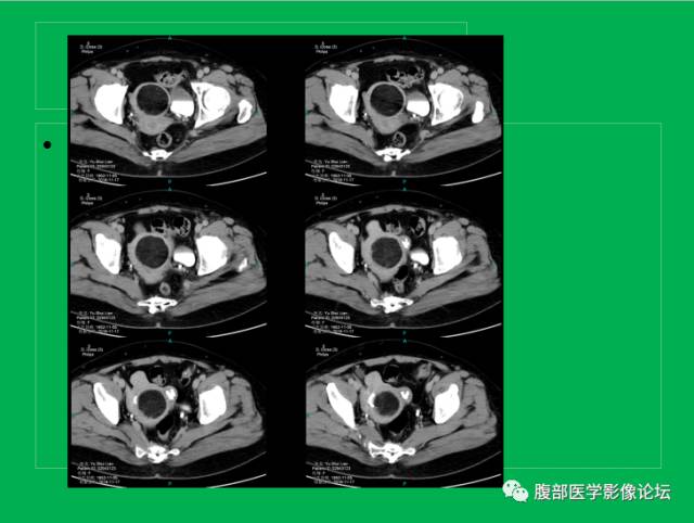 【病例】子宫肌瘤伴脂肪样变1例CT