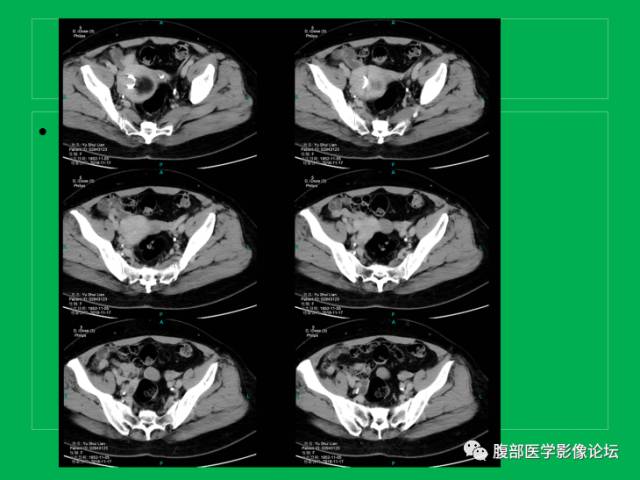 【病例】子宫肌瘤伴脂肪样变1例CT