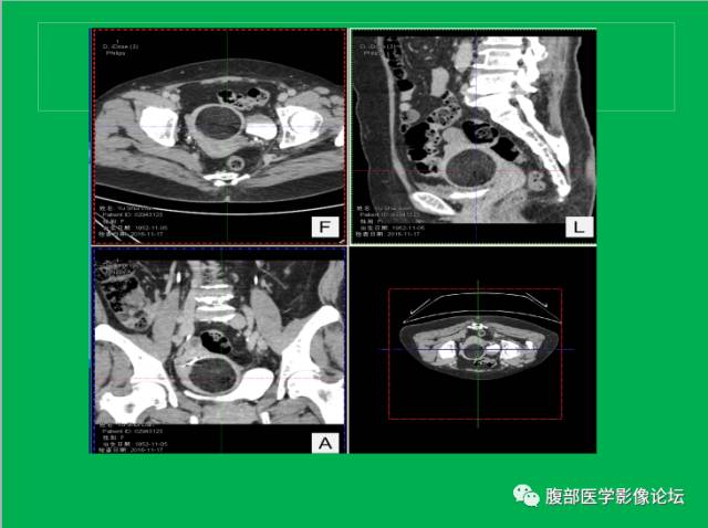 【病例】子宫肌瘤伴脂肪样变1例CT