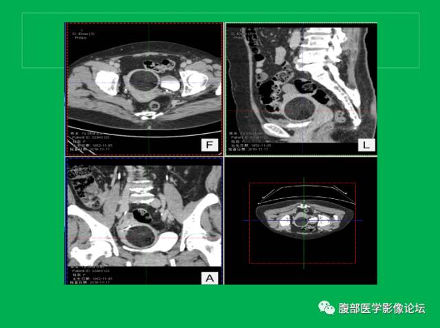 【病例】子宫肌瘤伴脂肪样变1例CT