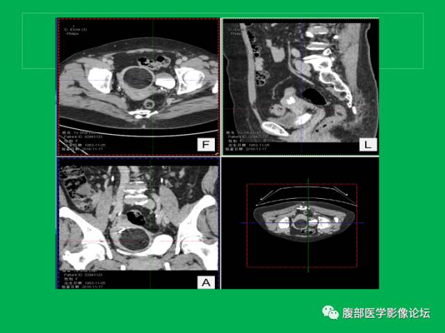 【病例】子宫肌瘤伴脂肪样变1例CT