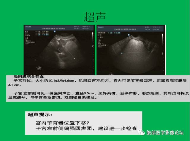 【病例】子宫肌瘤伴脂肪样变1例CT