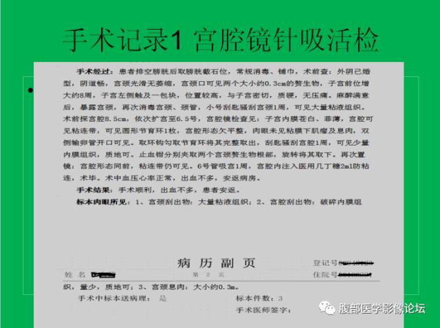 【病例】子宫肌瘤伴脂肪样变1例CT