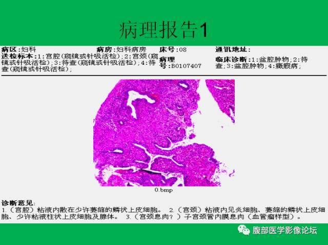 【病例】子宫肌瘤伴脂肪样变1例CT