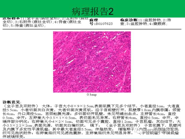 【病例】子宫肌瘤伴脂肪样变1例CT