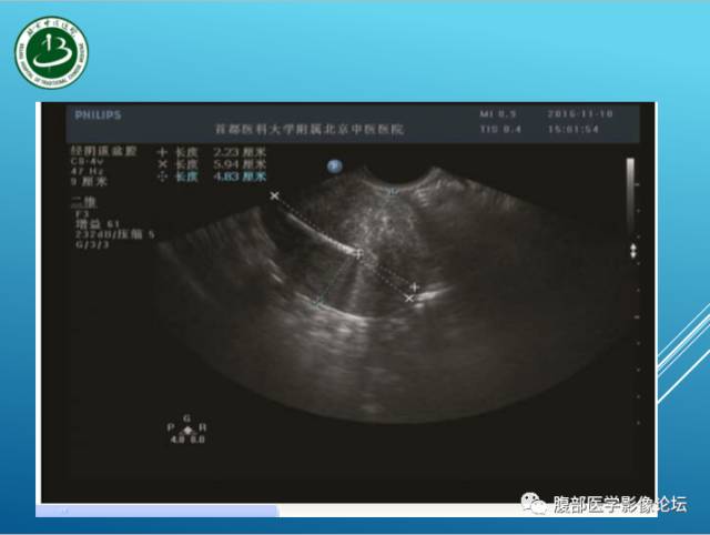 【病例】右侧阔韧带平滑肌瘤脂肪变性1例CT